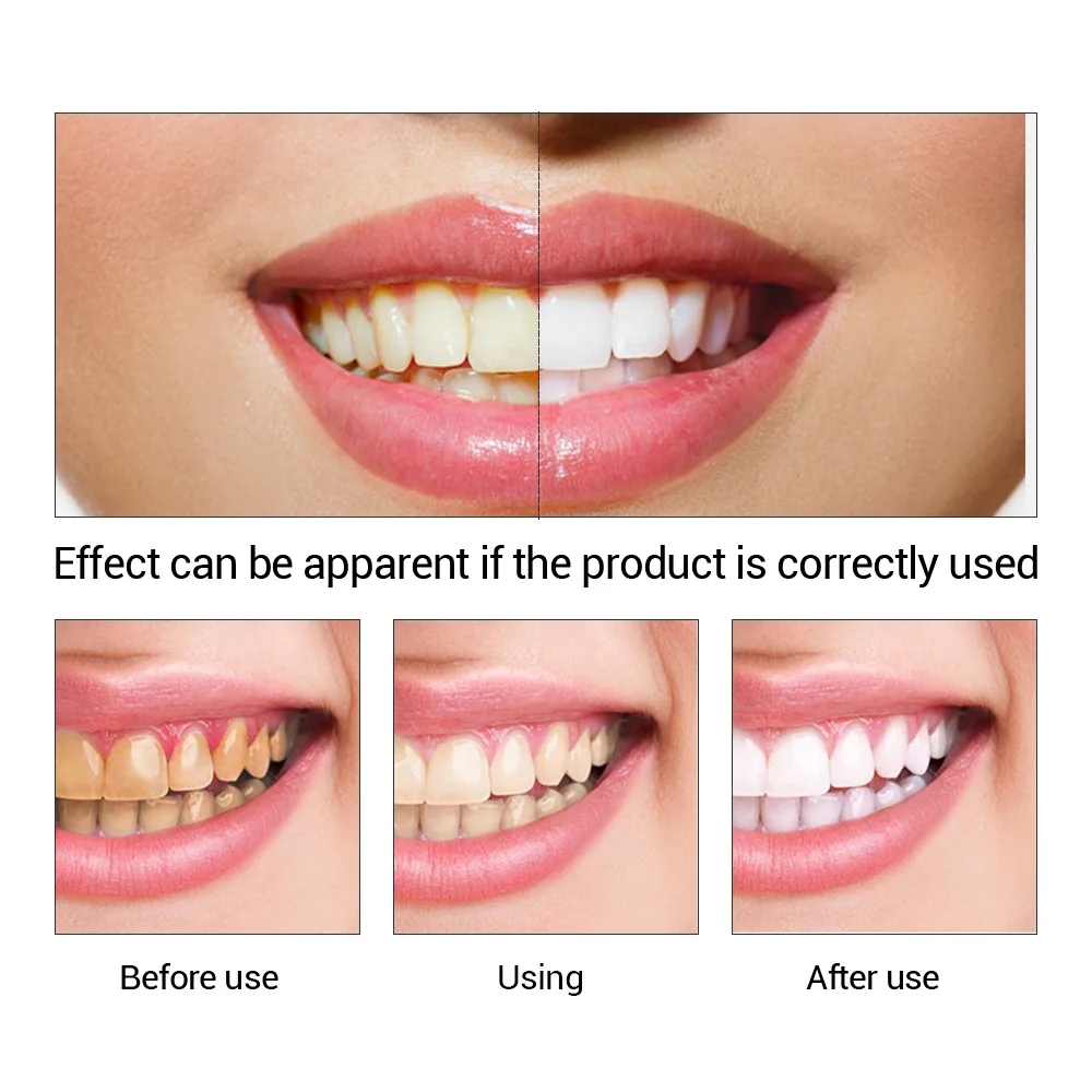 FTEENPLY Teeth Whitening Essen - огляд і ціна Teeth Whitening Near Me