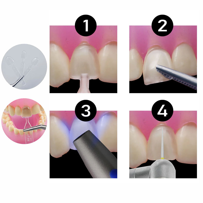 32pcs/Set Composite Resin Mold - огляд і ціна Teeth Whitening Moulds