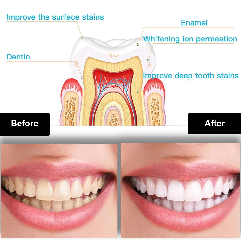 Dental Teeth Whitening Kit Min - огляд і ціна Teeth Whitening Near Me