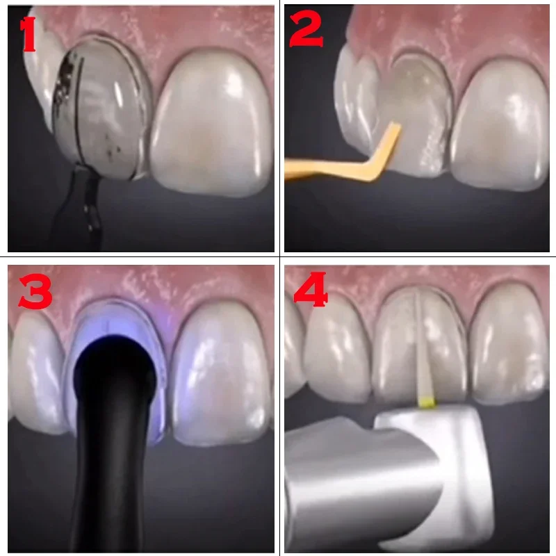 Dentals Mould For Composite Re - огляд і ціна Teeth Whitening Moulds