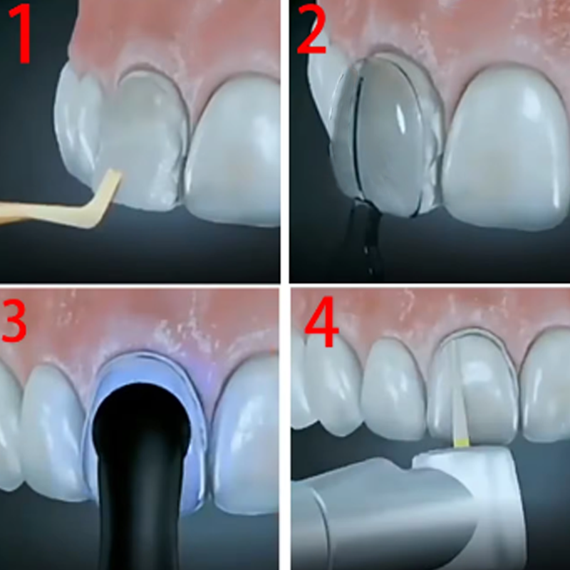 32Pcs/Box Dental Veneer Mould  - огляд і ціна Teeth Whitening Moulds